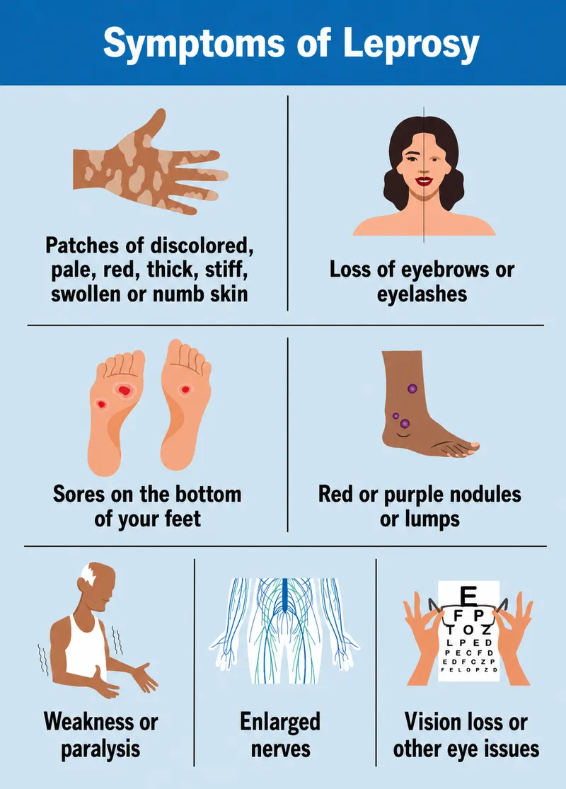 Symptoms of Leprosy