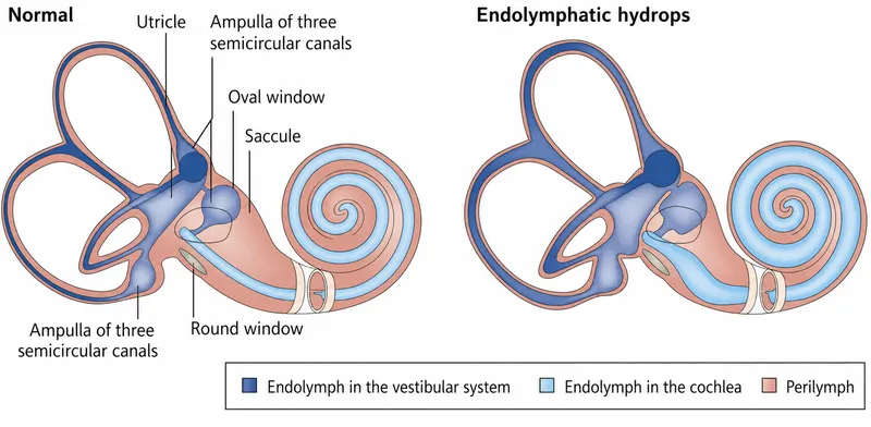Endolymphatic hydrops pathophysiology in Meniere's disease