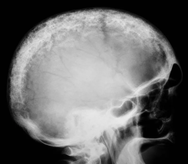 Paget's disease of skull, cotton wool appearance