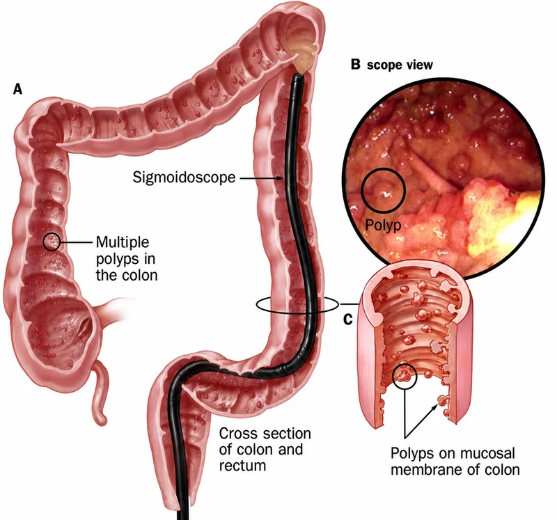 Sigmoidoscopy and colonic polyps