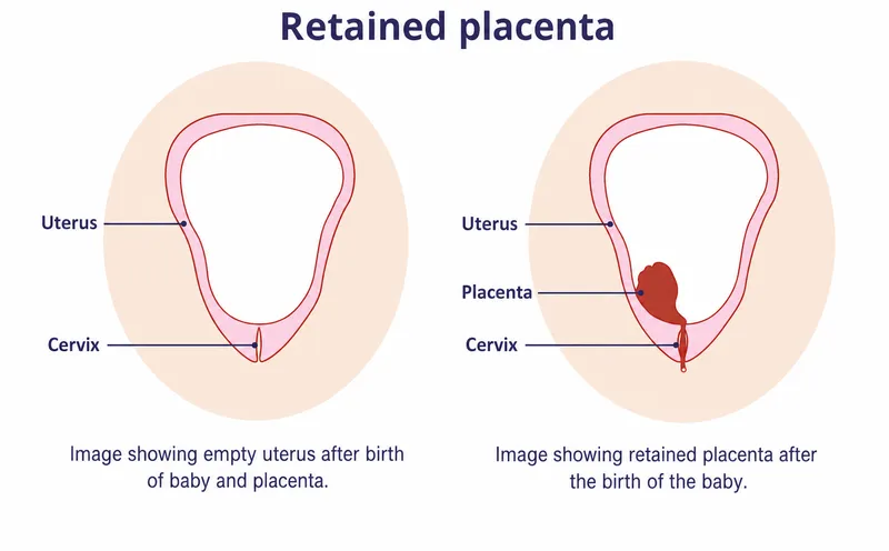Empty vs. Retained Placenta in Uterus