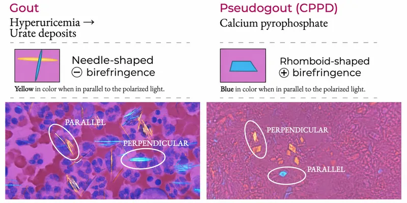 Gout and Pseudogout Crystals Under Polarized Light