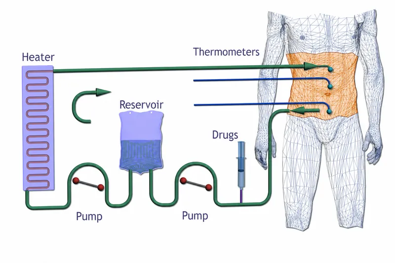 HIPEC Procedure Setup Diagram