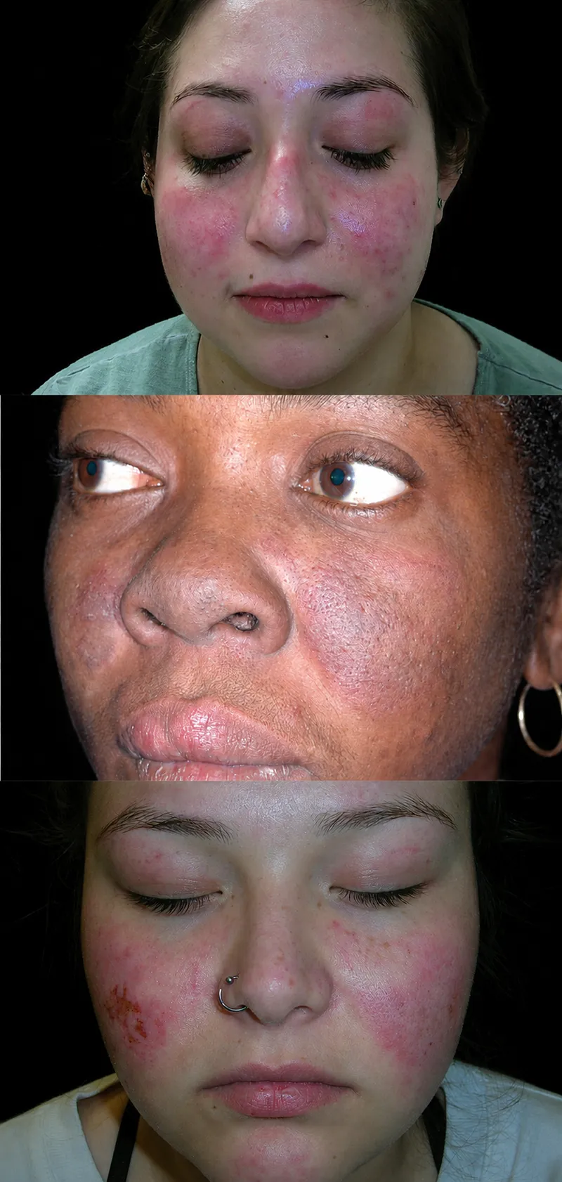 Acute Cutaneous Lupus Erythematosus (ACLE) Malar Rash