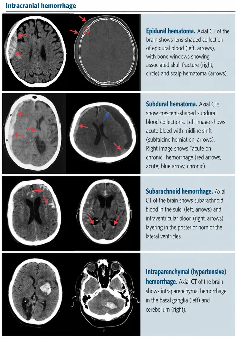 CT Comparison of Intracranial Hemorrhages