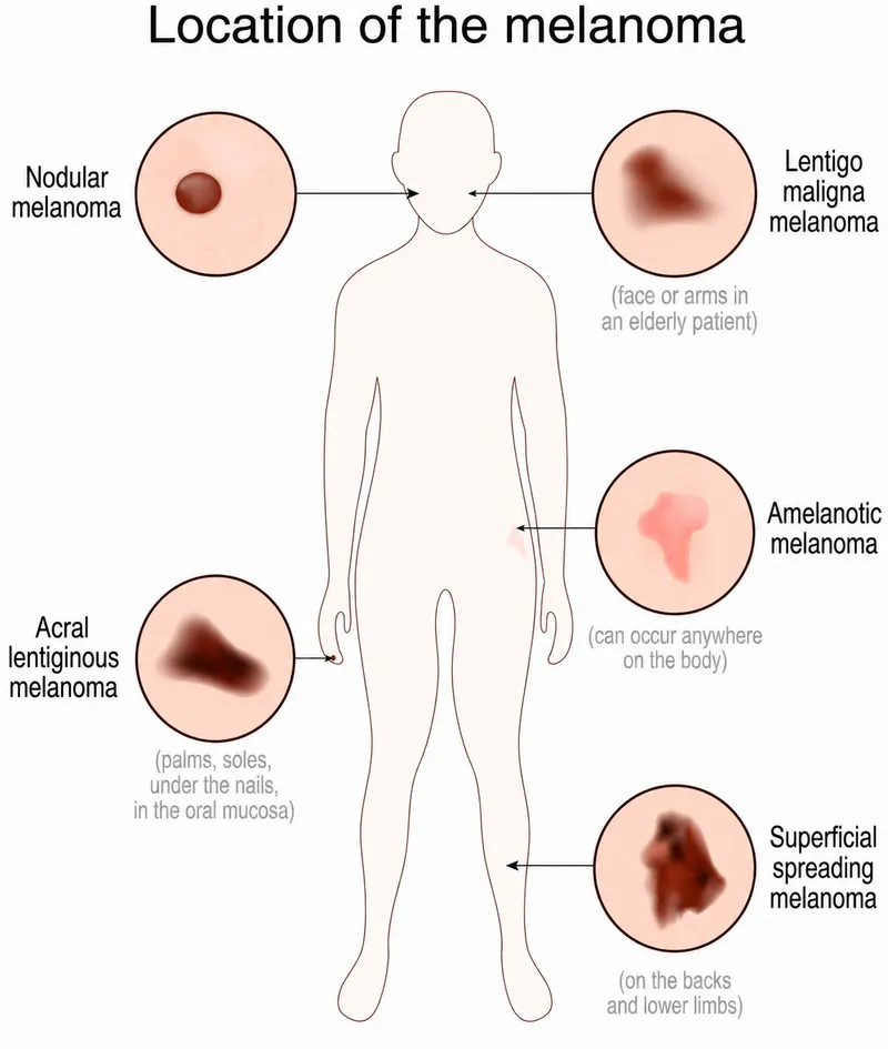 Melanoma types and locations