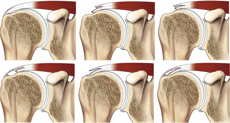 Rotator cuff tear classification diagram