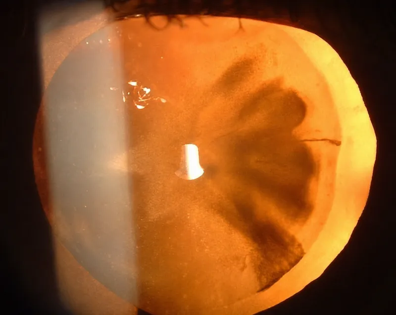 Traumatic Rosette Cataract