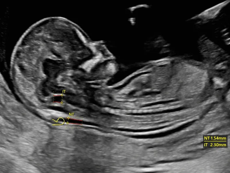 Fetal Nuchal Translucency (NT) Ultrasound Measurement