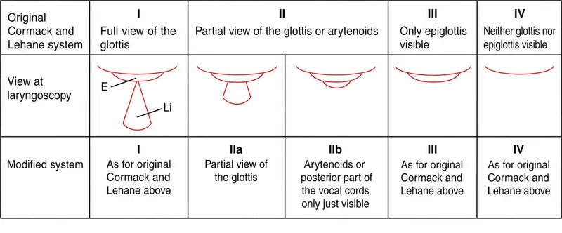 Cormack-Lehane Glottic Views Diagram