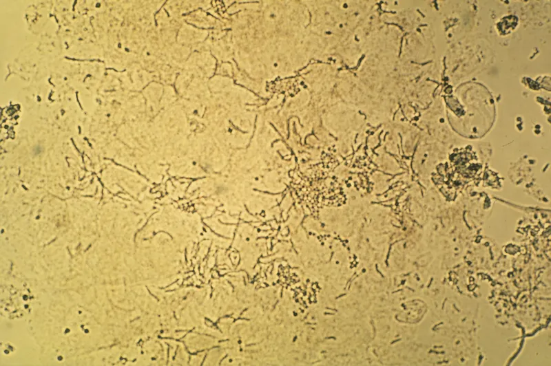 Malassezia yeast and hyphae ("spaghetti and meatballs")