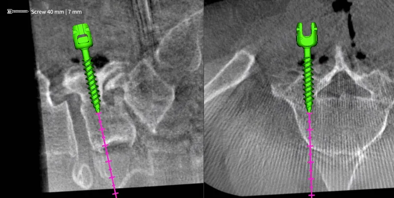 Spine navigation: pedicle screw planning