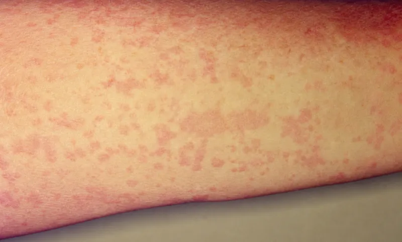 Evanescent salmon-pink rash of Systemic JIA