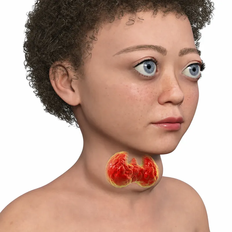 Pediatric Graves disease: exophthalmos and goiter