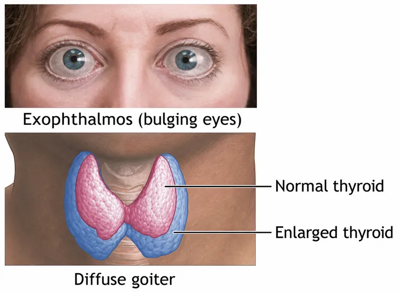 Graves' disease: exophthalmos and goiter