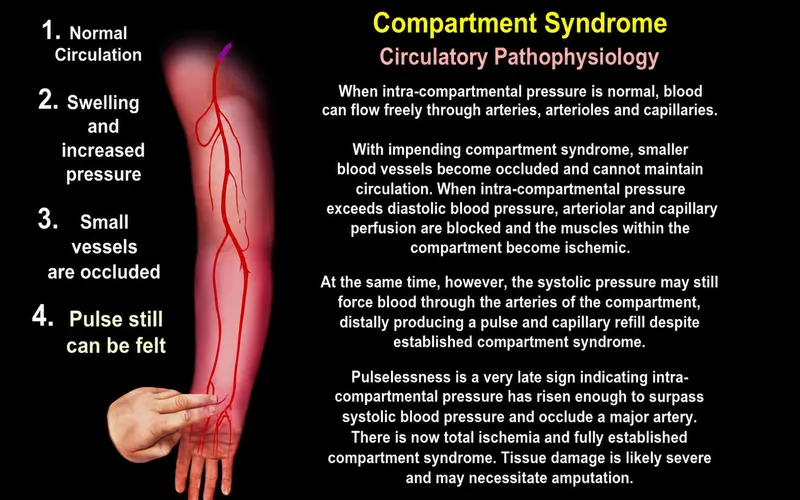 Compartment Syndrome Circulatory Pathophysiology