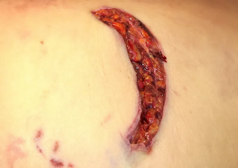 Sharp Force Trauma: Incised Wound with Ruler for Scale