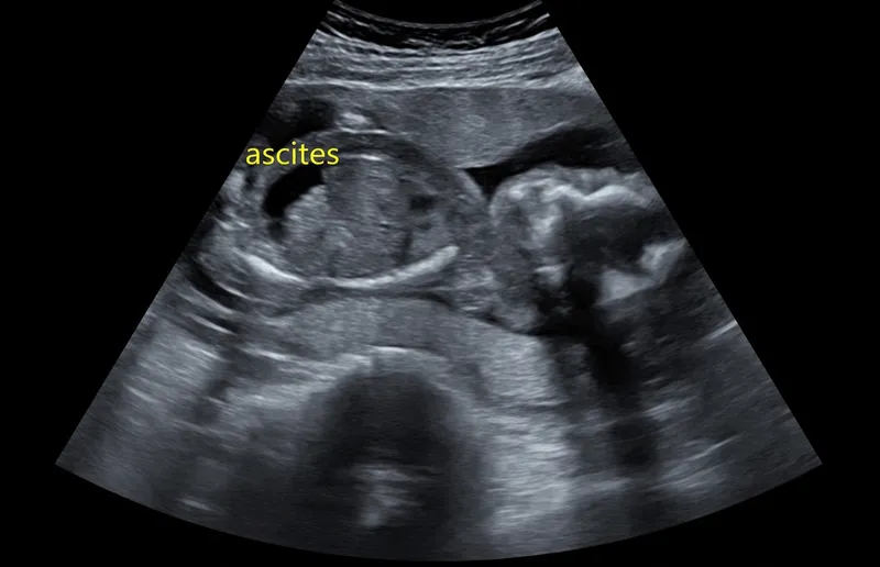 Ultrasound: Fetal ascites in hydrops fetalis