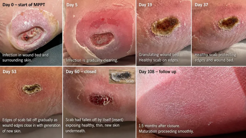 Healing of infected pressure injury on heel over 108 days