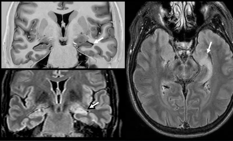 Figure 2: MRI brain T2 showing bilateral hippocampal atrophy in Alzheimer's disease