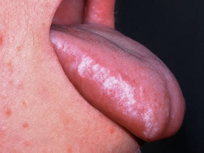 Oral Hairy Leukoplakia on tongue