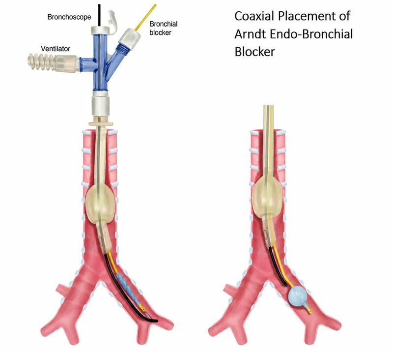 Coaxial Arndt Endo-Bronchial Blocker Placement