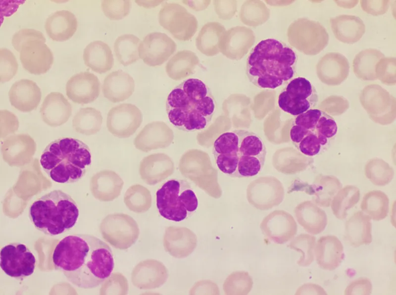 HTLV-1 flower cells in peripheral blood smear