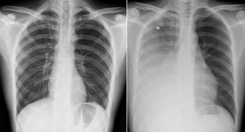 Chest X-ray: Lobar pneumonia causing physiological shunt