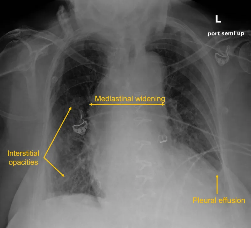 Chest X-ray: Widened mediastinum in Aortic Dissection