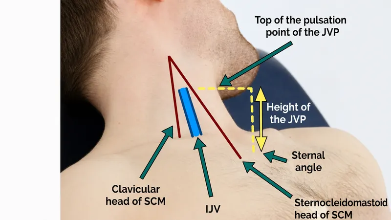 Jugular Venous Pressure (JVP) Measurement Technique