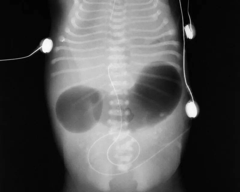 X-ray: Duodenal Atresia "Double Bubble" Sign