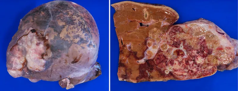 Liver abscess with fibrous capsule and necrotic center
