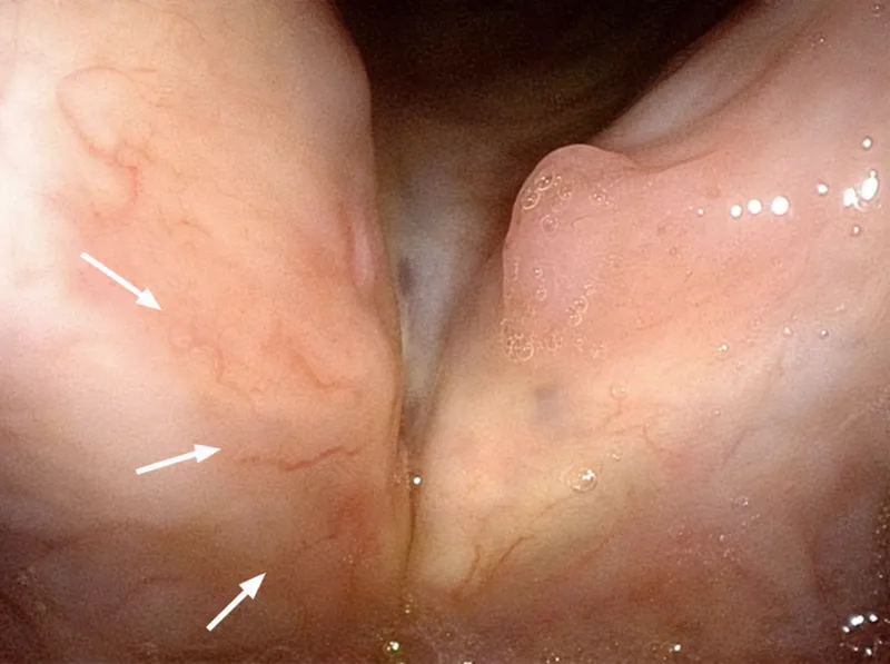 Laryngeal papilloma on laryngoscopy