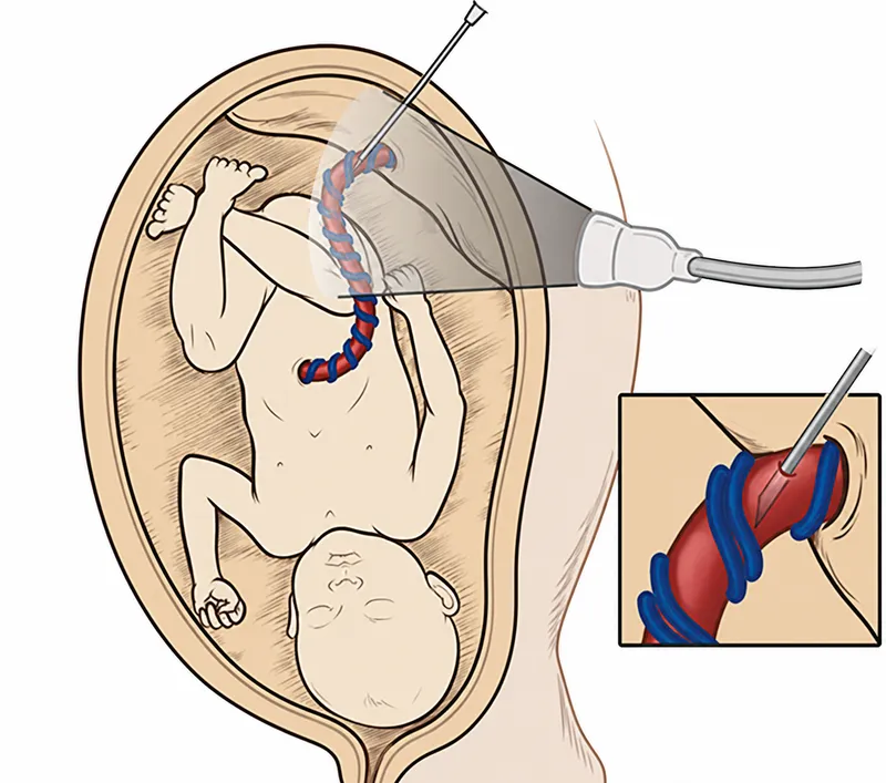 Intrauterine fetal therapy procedure illustration