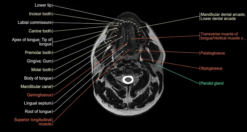 Axial MRI of oral cavity with labeled anatomical structures