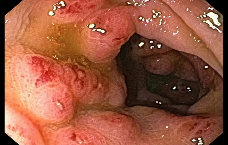Gastrointestinal manifestations of parasitic infections