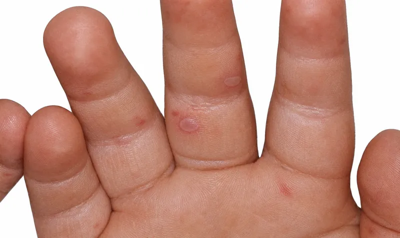 HFMD Vesicular Rash on Fingers