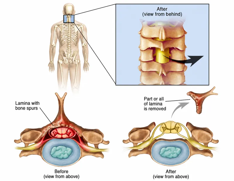 Laminectomy for Spinal Stenosis