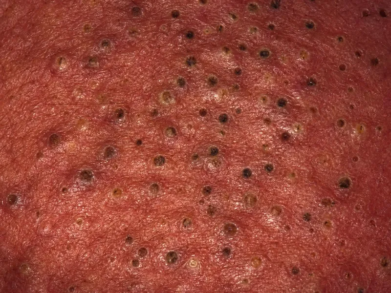 Occupational Chloracne Lesions