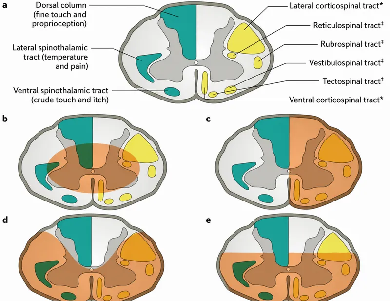 Spinal cord syndromes cross-section diagram