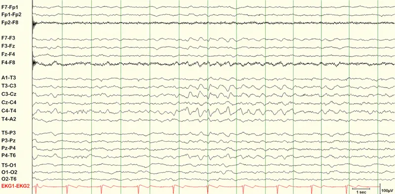 EEG of REM sleep with sawtooth waves