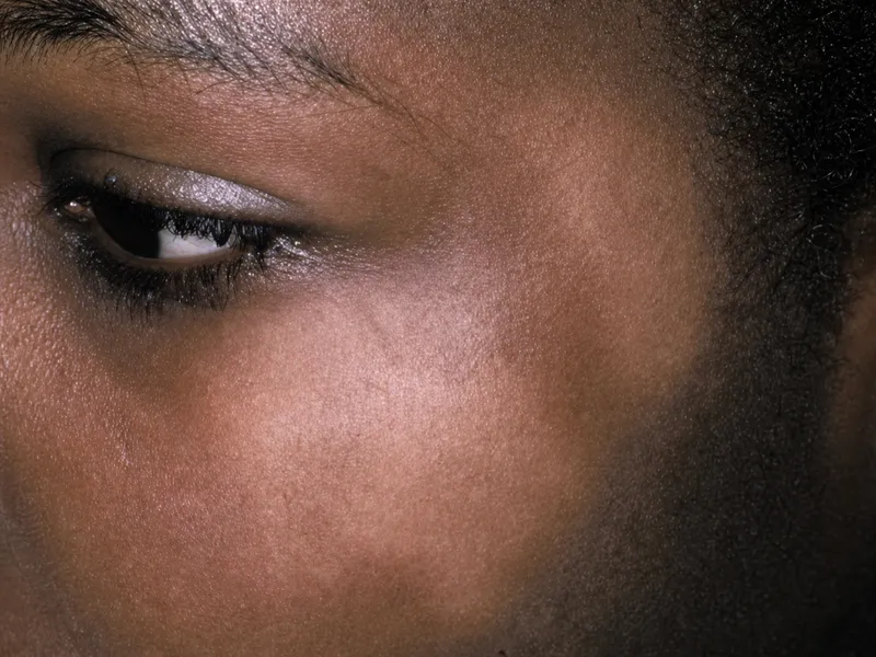 Pityriasis Alba on Child's Face