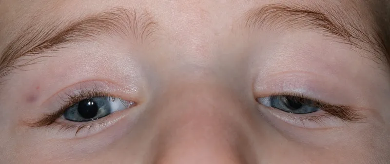 CFEOM with bilateral ptosis and downgaze fixation