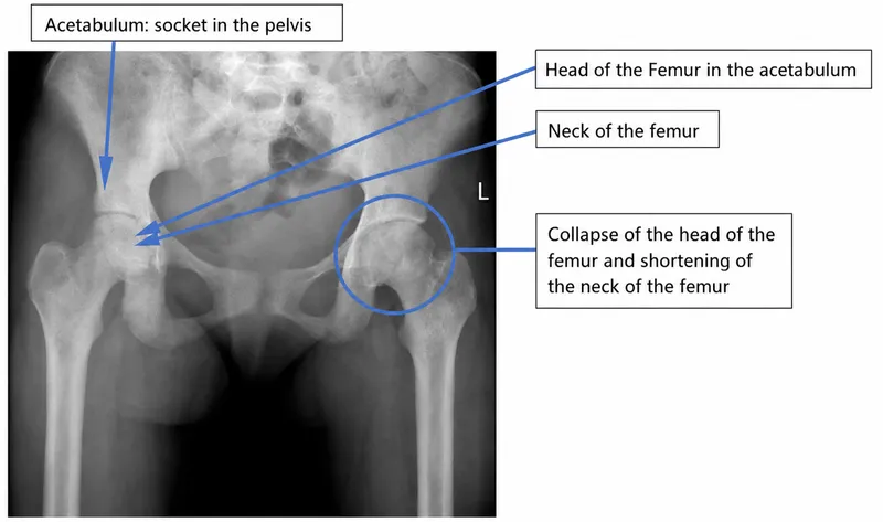 X-ray: Avascular necrosis of femoral head in sickle cell