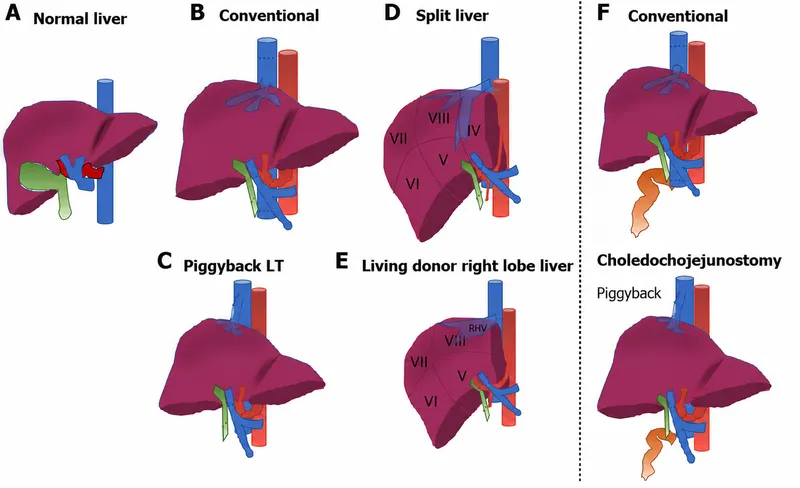 Liver Transplant Anastomotic Sites and Techniques