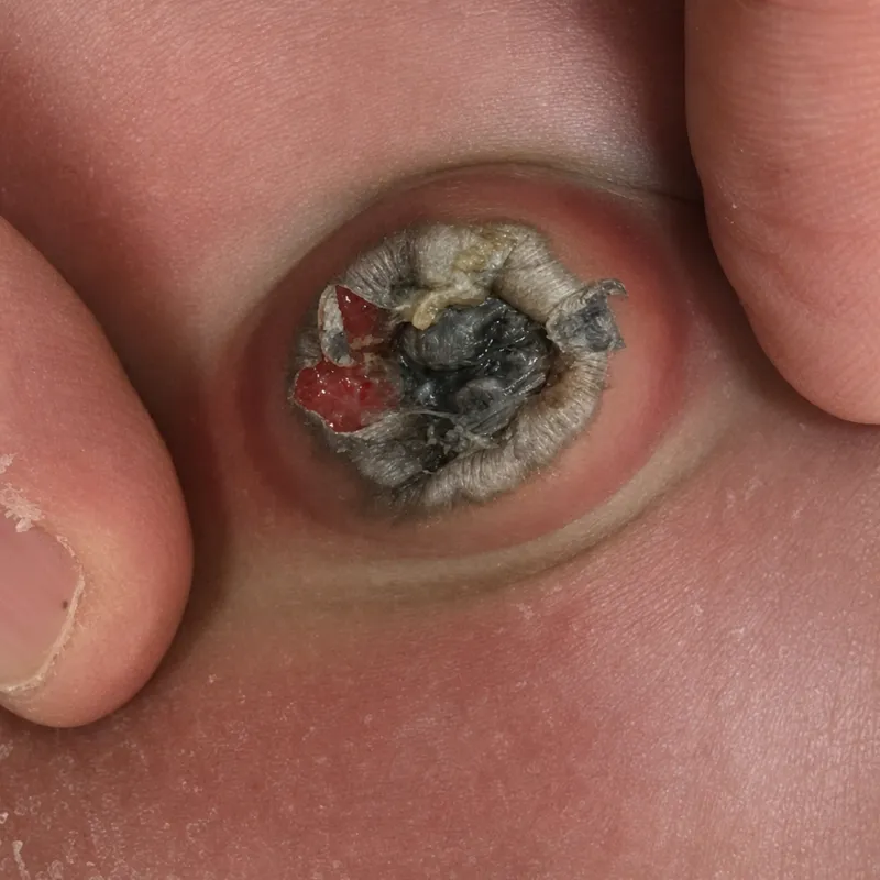Neonatal Omphalitis with Purulent Discharge
