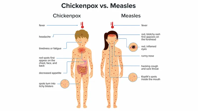 Measles vs. Chickenpox Symptoms