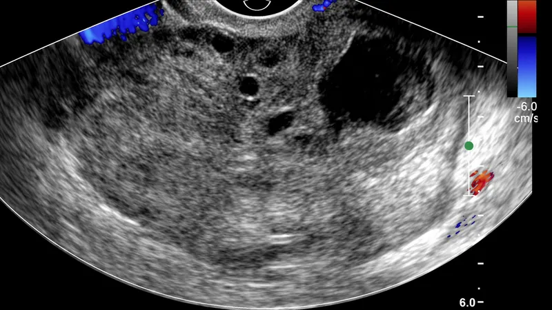 Ultrasound of ovarian torsion