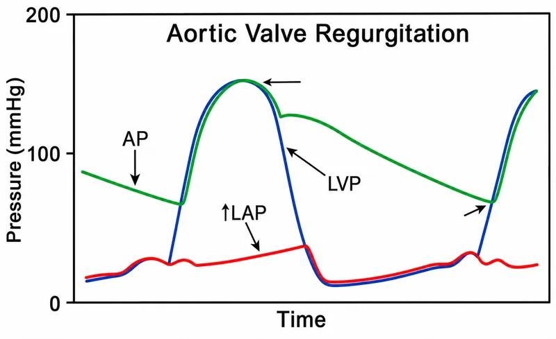 Aortic valve regurgitation pressure-time graph