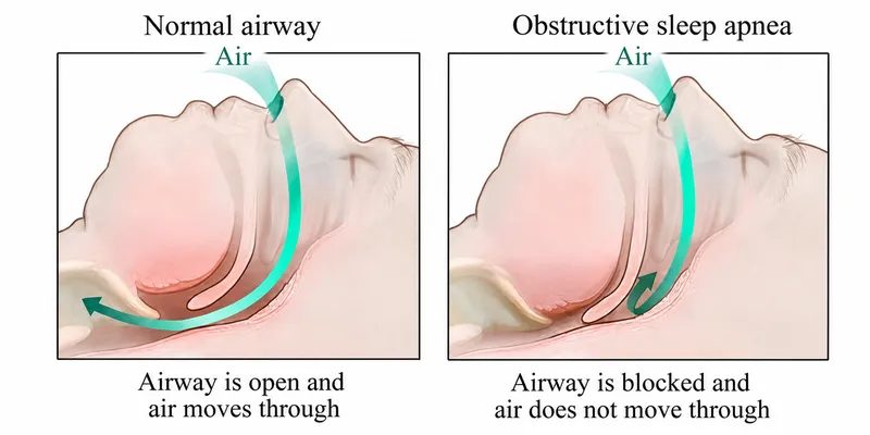 Normal vs. Obstructed Airway in Sleep Apnea